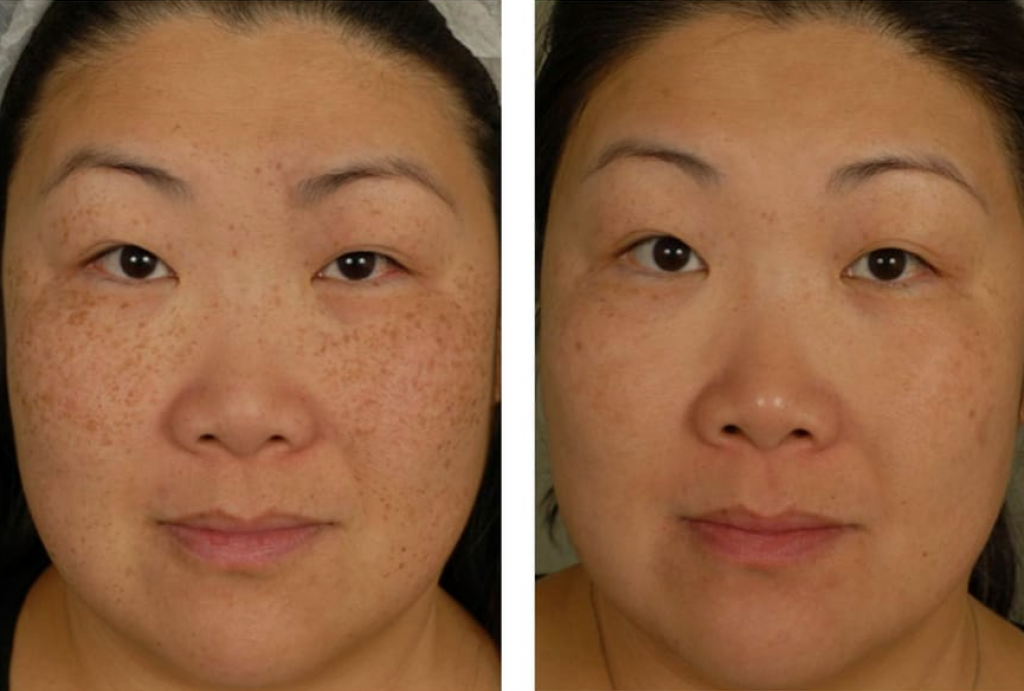 RF microneedling for hyperpigmentation before and after