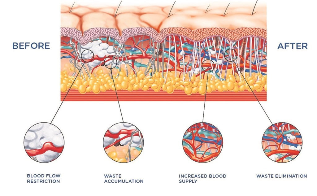 What is Shockwave Therapy Workout and how does it Work?