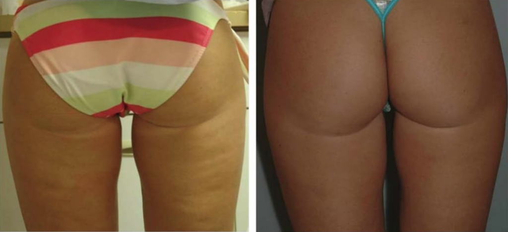 Cellulite Reduction VELASHAPE  Las Vegas Nevada, Bullhead City, Laughlin