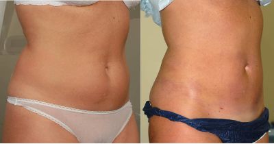 Say Goodbye to Lipo 360 Scars with CureIndia's Expert Care - Rejuve India  Meditour Pvt. Ltd. - Medium