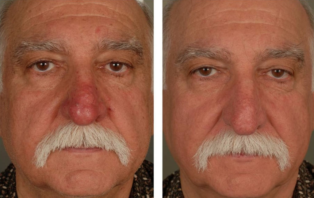 Natural Lift, Lip Lift, CO2 Laser 427 Before After Photos Orange County