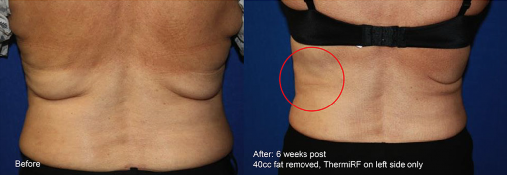 How to Tighten Loose Skin After Bariatric Surgery? Los Angeles